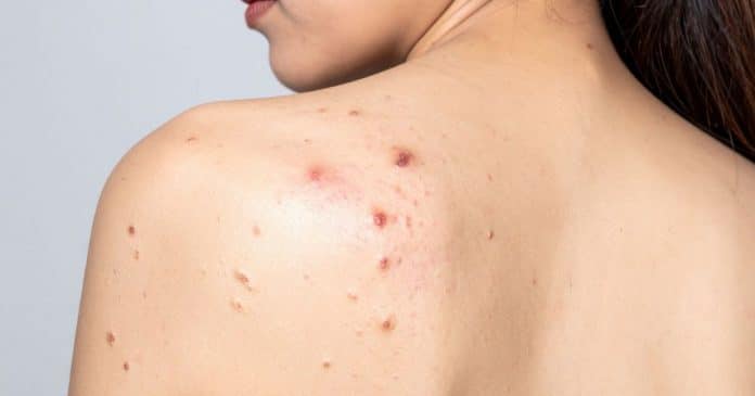Acne nas costas não é falta de banho: O erro que quase todo mundo comete ao tentar tratar