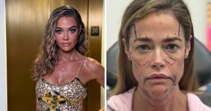 Ícone da beleza, Denise Richards choca fãs com fotos impressionantes de antes e depois de cirurgia plástica no rosto