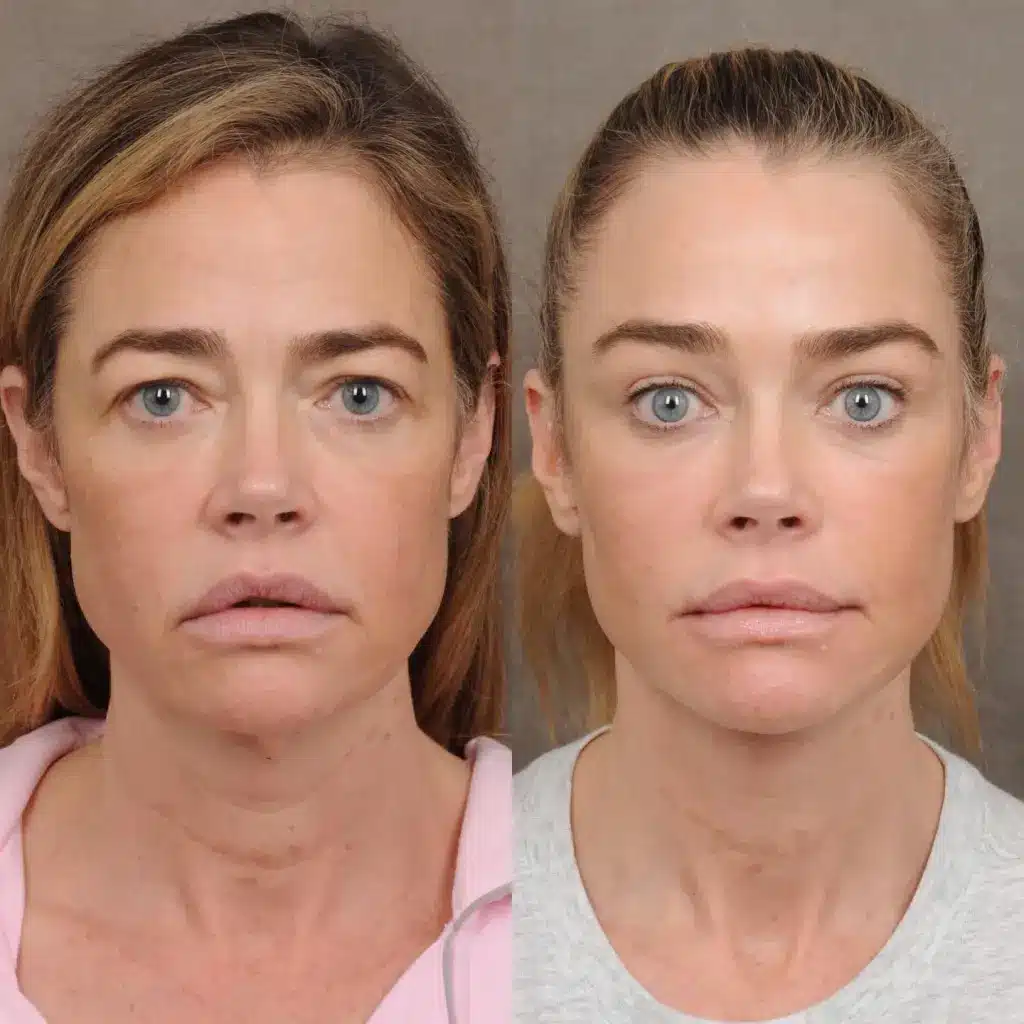 sabiaspalavras.com - &Iacute;cone da beleza, Denise Richards choca f&atilde;s com fotos impressionantes de antes e depois de cirurgia pl&aacute;stica no rosto
