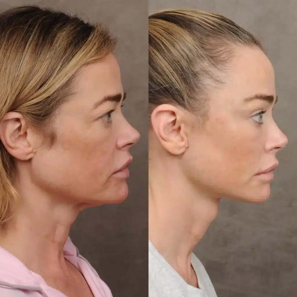 sabiaspalavras.com - &Iacute;cone da beleza, Denise Richards choca f&atilde;s com fotos impressionantes de antes e depois de cirurgia pl&aacute;stica no rosto