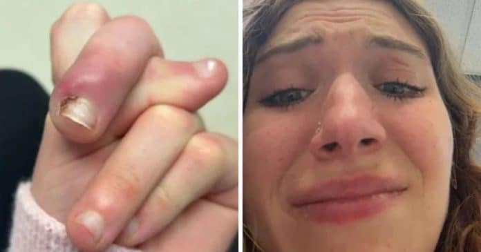 Roer unhas quase custou um dedo: jovem de 21 anos vive drama assustador após infecção gravíssima