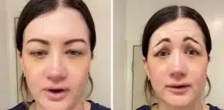 Mulher investe R$ 2.700 em Botox e resultado impressiona pela mudança inesperada no rosto