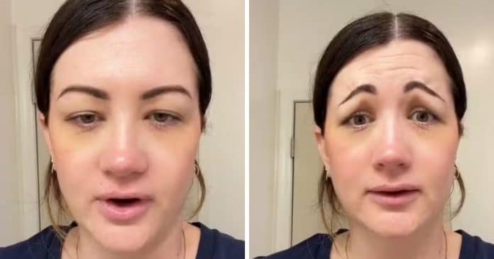 Mulher investe R$ 2.700 em Botox e resultado impressiona pela mudança inesperada no rosto