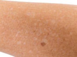 Notou ‘pequenas manchas brancas na pele’ dos braços ou pernas? Veja o que elas podem significar