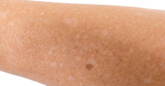 Notou ‘pequenas manchas brancas na pele’ dos braços ou pernas? Veja o que elas podem significar