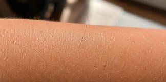 Por que aparece um ‘único pelo longo’ do nada no corpo?