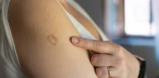 Poucas pessoas sabem o motivo dessa marca no braço que milhões possuem