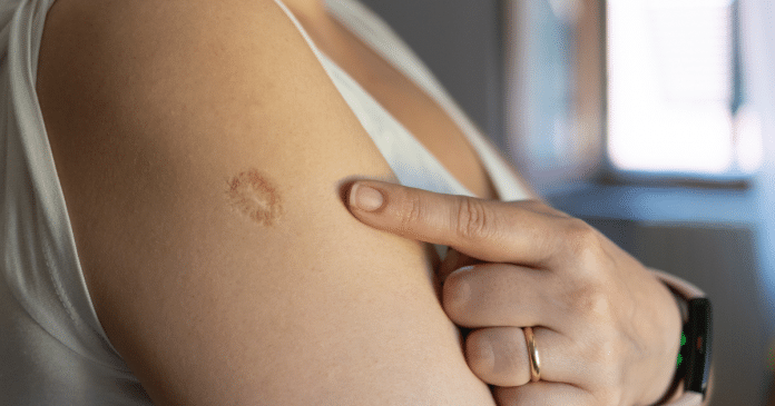Poucas pessoas sabem o motivo dessa marca no braço que milhões possuem