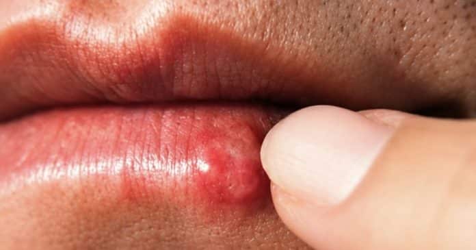 se-essa-marca-aparecer-na-boca-e-isso-que-seu-corpo-esta-tentando-avisar Se essa marca aparecer na boca, é isso que seu corpo está tentando avisar…
