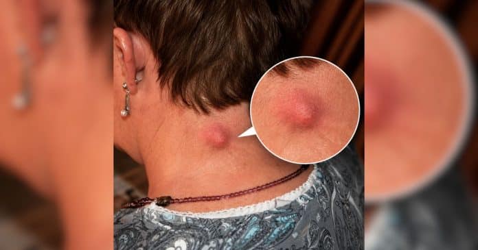 Essas bolinhas na pele parecem acne, mas podem indicar outro problema