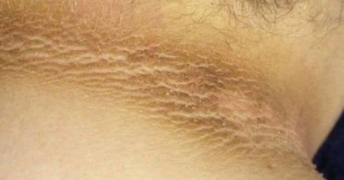Pele escurecida e aveludada no pescoço, axilas ou virilha pode ser sinal DESSA doença e poucos sabem