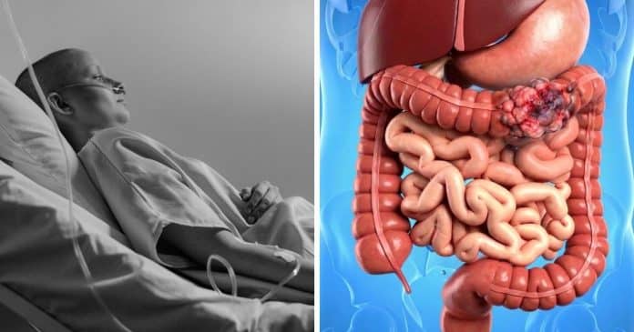 Câncer de intestino: 4 alimentos muito comuns que podem aumentar o risco — e um deles está na sua mesa todos os dias