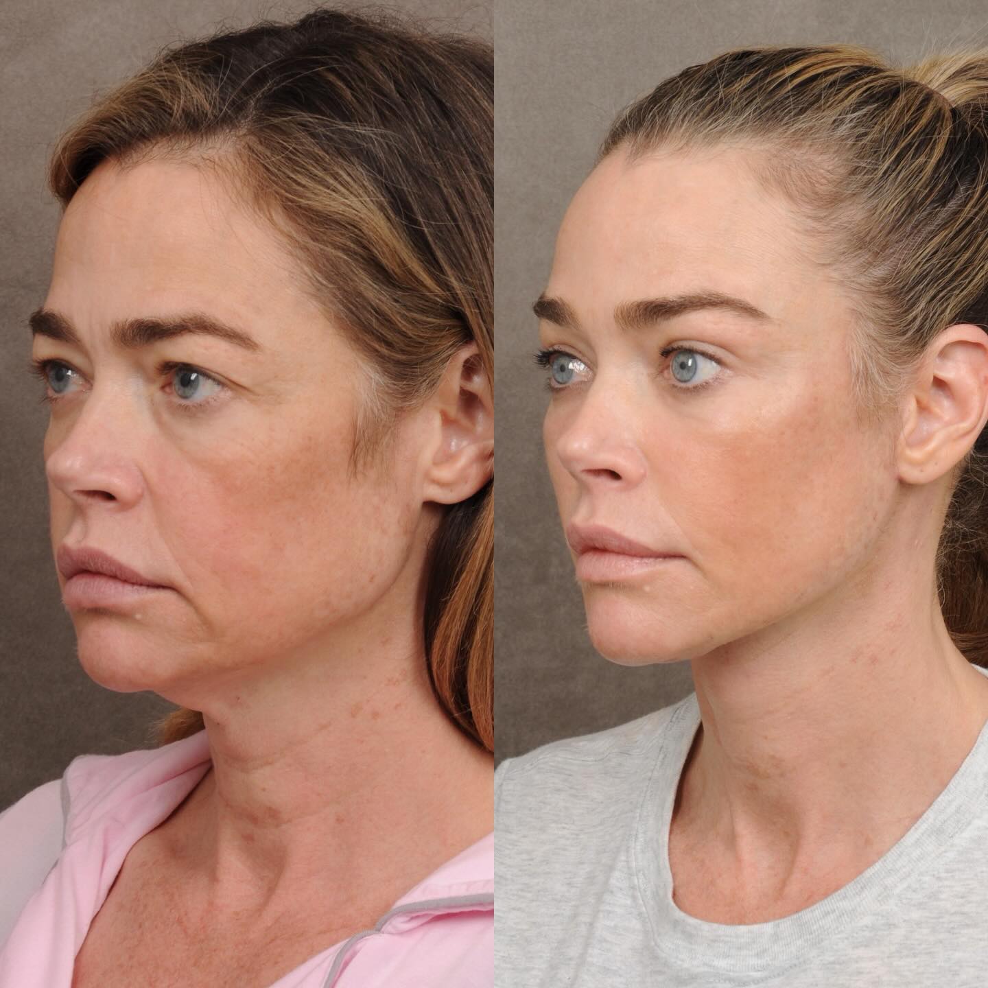 sabiaspalavras.com - Denise Richards impressiona com antes e depois de facelift de R$1 milh&atilde;o: &ldquo;transplante de cabe&ccedil;a&rdquo;
