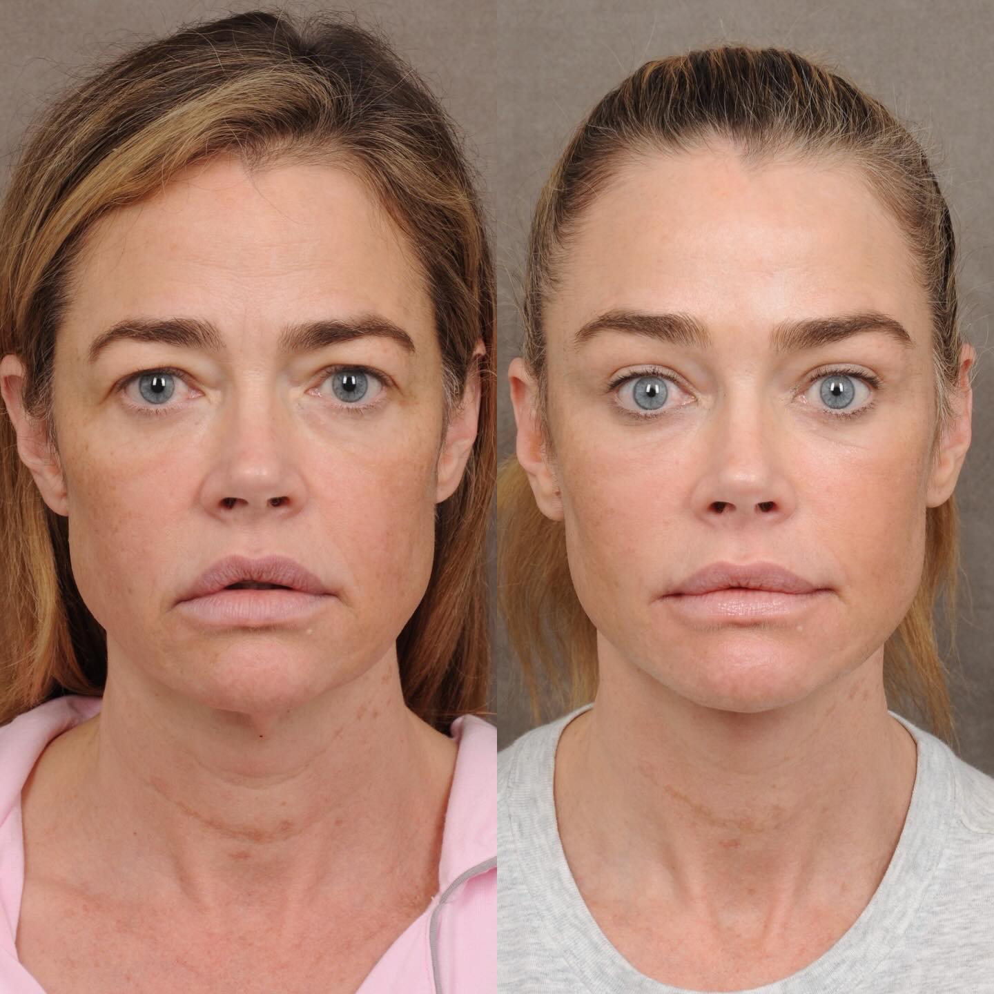 sabiaspalavras.com - Denise Richards impressiona com antes e depois de facelift de R$1 milh&atilde;o: &ldquo;transplante de cabe&ccedil;a&rdquo;