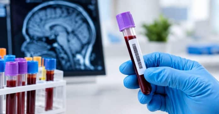 PRIMEIRO exame de sangue para Alzheimer chega ao Brasil: veja quanto custa e quem pode fazer